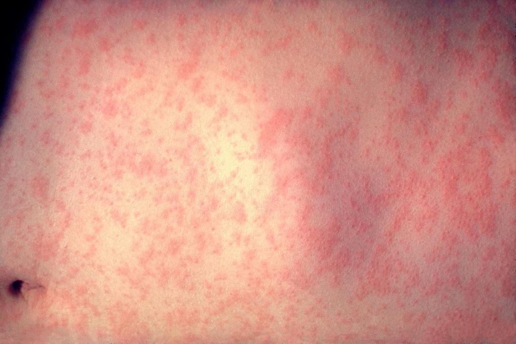measles rash
